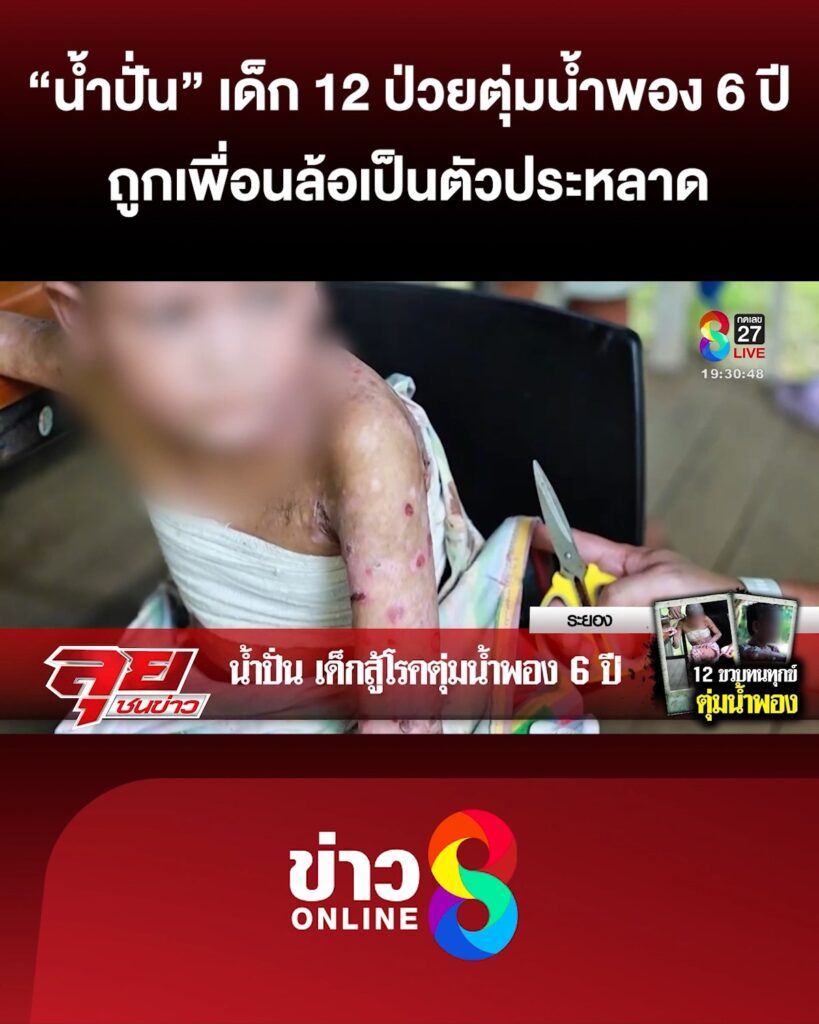 น้ำปั่น-เด็ก-12-ป่วยตุ่มน้ำพอง-6-ปี-ถูกเพื่อนล้อเป็นตัวประหลาด-|-ลุยชนข่าว-ออนไลน์-|-8-พ.ค