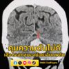 แพทย์-ยกเคส-หญิงวัย-58-ปี-เลืoดออกสมองน้อยเฉียบพลัน-สาเหตุจา-|-2025-07-07-05:54:00