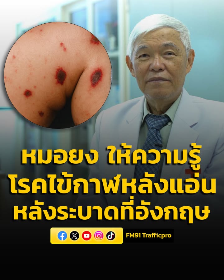 หมอยง-ให้ความรู้-“โรคไข้กาฬหลังแอ่น”-หลังพบระบาดหนักที่อังกฤ-|-2026-03-18-03:23:00