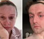 “ฉันเป็นโรคผื่นภูมิแพ้ผิวหนังมาตลอดชีวิต-แต่ครั้งนี้มันต่างออกไป”-รู้จัก-tsw-อาการถอนยาทาสเ