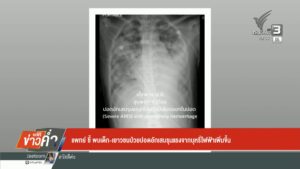 แพทย์-ชี้-พบเด็ก-เยาวชนป่วยปอดอักเสบรุนแรงจากบุหรี่ไฟฟ้าเพิ่