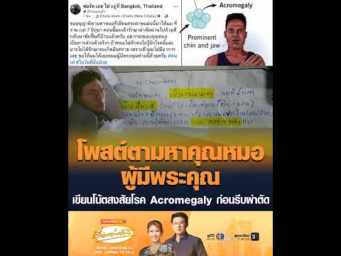 โพสต์ตามหาคุณหมอผู้มีพระคุณ เขียนโน้ตสงสัยโรค Acromegaly ก่อนรีบผ่าตัด อัพเดทข่าว